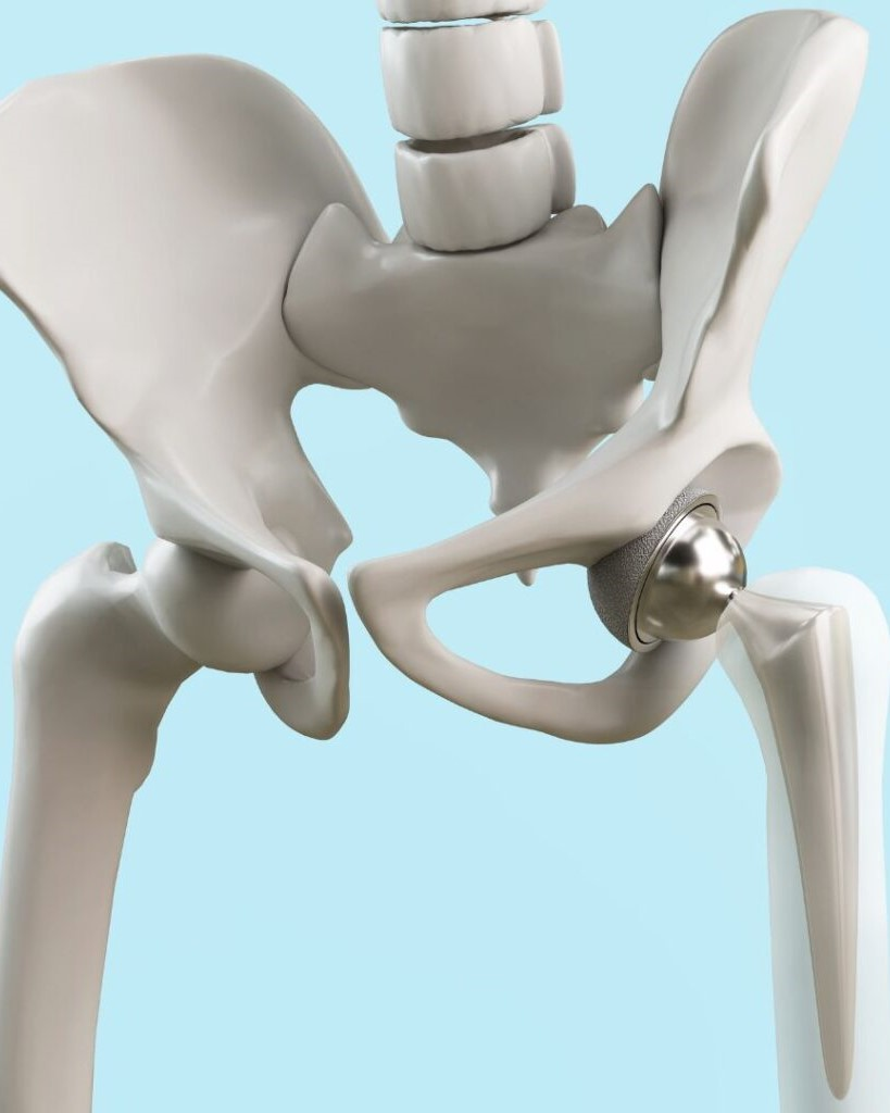 Robotic Hip Replacement in Mumbai